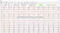 ECG digitale Spengler Cardiomate PC-ECG (12 canali)